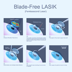LASIK Eye Surgery Los Angeles | Laser Vision Medical Associates